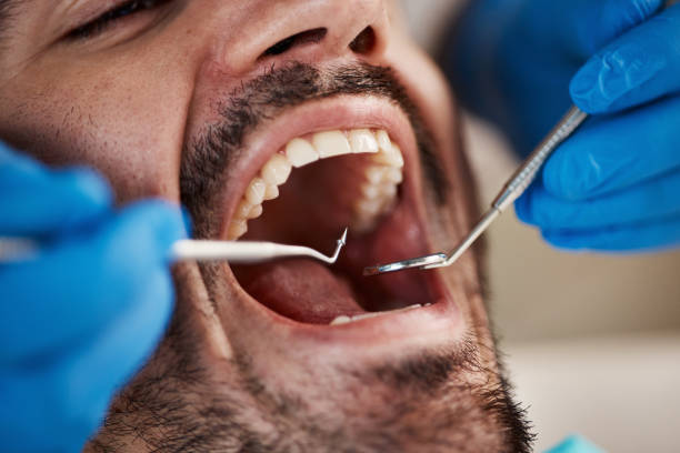 Best Emergency Wisdom Tooth Extraction in Itasca, IL